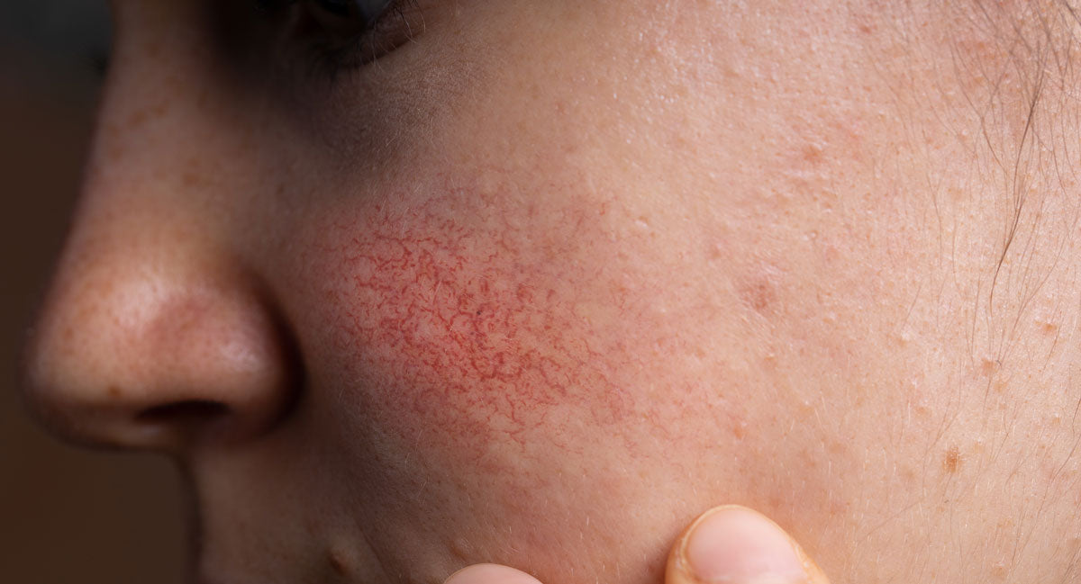 ¿Dermatitis o Rosácea? ¿Cómo reconocerla? Tienda Cresso